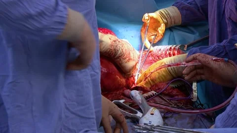 Surgeon operation. Doctors performing operation with the surgery tools. Stock Footage 148904171