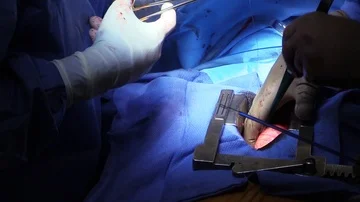 Surgeon in operation Stock Footage 85900018