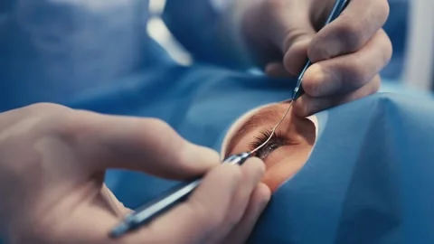 Surgeon performing delicate eye surgery with precision instruments, focusing on Stock Footage 337285994