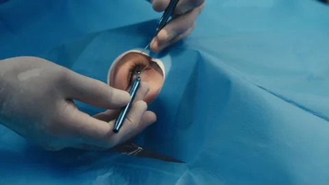Surgeon performing delicate ophthalmic surgery on a patient's eye, using Stock Footage 337286036
