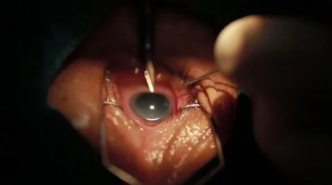 Surgeon performing an eye operation Stock Footage 62923812