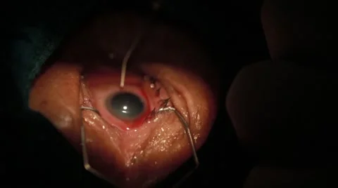 Surgeon performing an eye operation Stock Footage 62923815