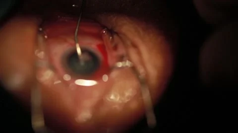 Surgeon performing an eye operation Stock Footage 62923816