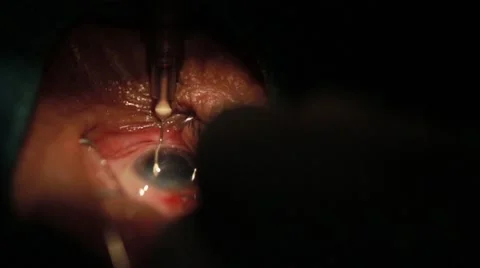 Surgeon performing an eye operation Stock Footage 62923818