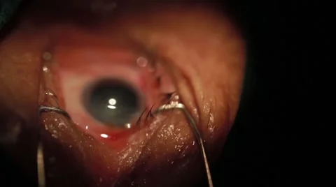 Surgeon performing an eye operation Stock Footage 62923819