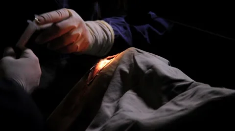 Surgeon performing an eye operation Video stock 62923881