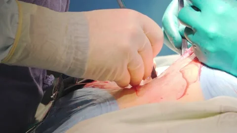 Surgeon performing heart surgery. Close-up. Operating room. Stock Footage 149770951