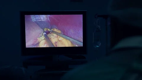 Surgeon performing laparoscopic surgery. Video stock 132205292