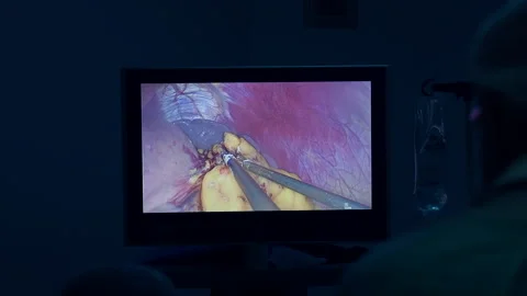 Surgeon performing laparoscopic surgery. Stock Footage 132205443