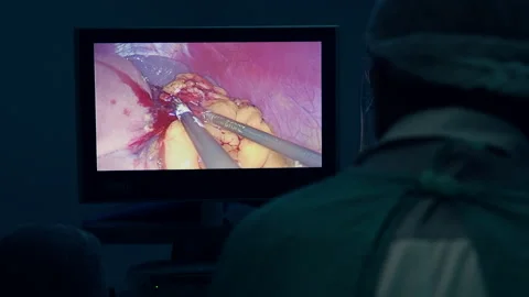 Surgeon performing laparoscopic surgery. Video stock 132205529
