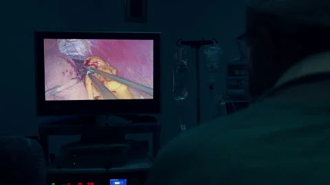 Surgeon performing laparoscopic surgery. Video stock 132205614