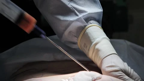 Surgeon performing liposuction surgery close-up Stock Footage 213938210