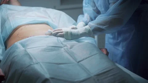 Surgeon performs abdominal procedure with precision and skill in a clinical Vídeos de archivo 295864522