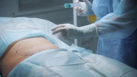 Surgeon performs abdominal puncture prior to liposuction procedure in a clinical Stock Footage 295865398