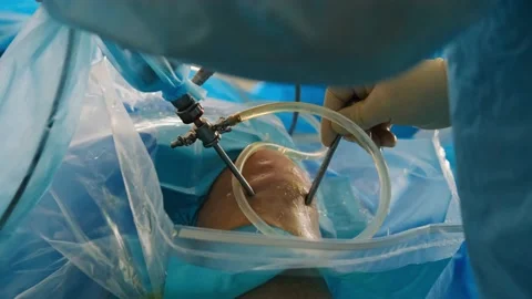 The surgeon performs endoscopic manipulation on the kneecap. The doctor does Stock Footage 201387956