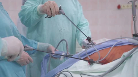 The surgeon performs an endoscopic operation on the organs of the abdominal Stock Footage 92145312
