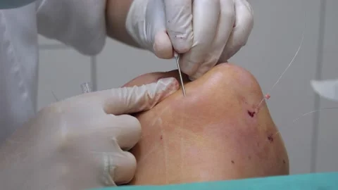 The surgeon performs a facelift operation Stock Footage 165822316