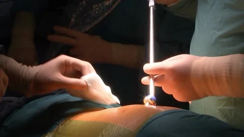 Surgeon performs a laparoscopic surgery. Clouse-up of doctor's hands and the Stock Footage 150748383