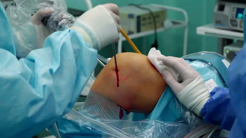 The surgeon performs the operation on the meniscus 스톡 동영상 164329573