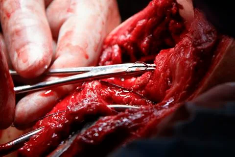 Surgeon pulls out the cannula by the forceps from the tissue macro Photos