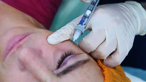 The surgeon puts an injection in the eye. Plastic surgery. Transconjunctival Stock Footage 145602450