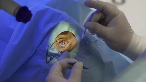 Surgeon removes part of the cornea from eye with tweezers after laser exposure Stock Footage