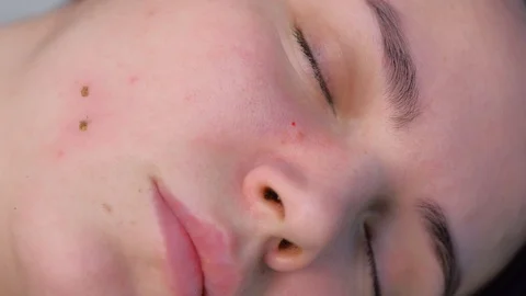 Surgeon removing mole using laser on woman face, burning skin, beauty treatment. Video stock 129608732