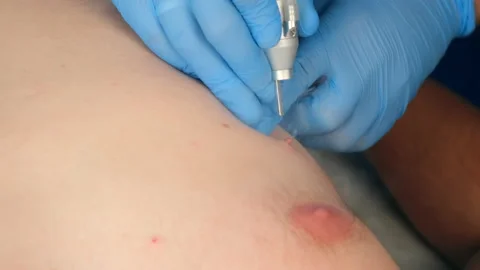 Surgeon removing mole using laser on man's body, burning skin, closeup view. Stock Footage 145527330