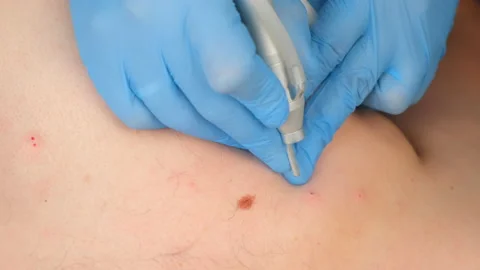 Surgeon removing moles using laser on man's body, burning skin, closeup view. Stock Footage 145299928