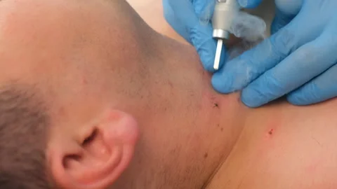Surgeon removing moles using laser on man's neck, burning skin, closeup view. Stock Footage 145300026