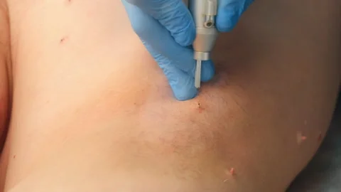 Surgeon removing papilloma using laser on man body, burning skin, closeup view. Video stock 146329624
