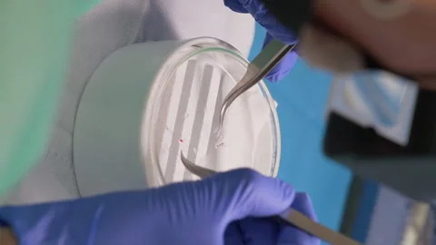 Surgeon selecting and classifying follicular units with tweezers for hair Stock Footage 250959046