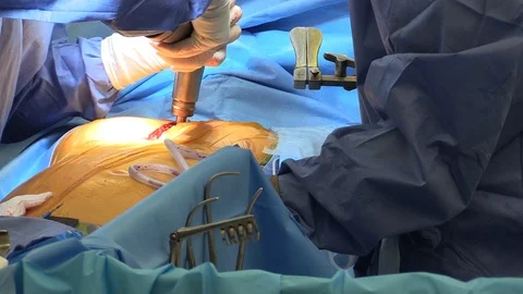 Surgeon starting the operation Stock Footage 85896656