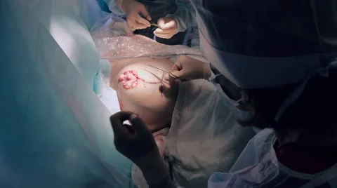 Surgeon suturing the breast to complete the surgery of reimplantation Stock-Footage 68930878