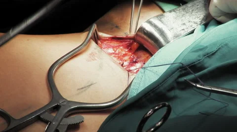 Surgeon suturing an open vein close up Stock Footage 67286177
