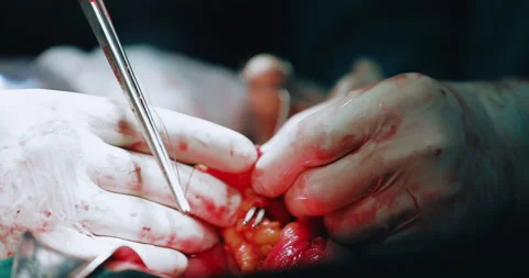 Surgeon suturing a wound inside patient in operation Stock Footage 130356328