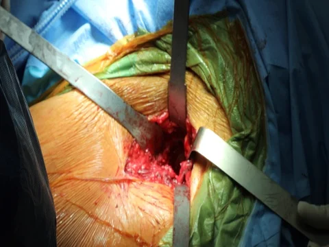 Surgeon working on a patient leg during surgery screwing and drilling Stock Footage 80273711