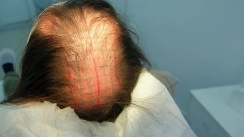 Surgeon writing red grid on man head with alopecia preparing to hair transplant. Stock Footage 311881192