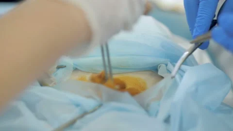 Surgeons are operating. Close up detail of a surgery Video stock 146217064
