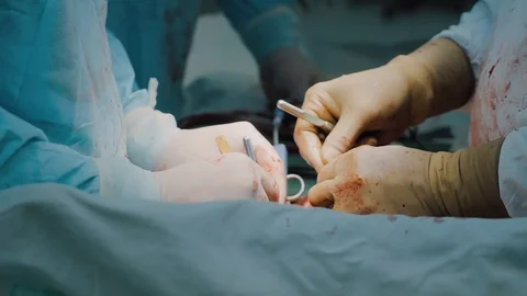 Surgeons are performing abdominal operation, close-up of hands Video stock 99514816