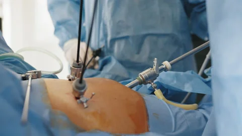 The surgeon's doing laparoscopic surgery in the operating room. Minimally Stock Footage 173408964