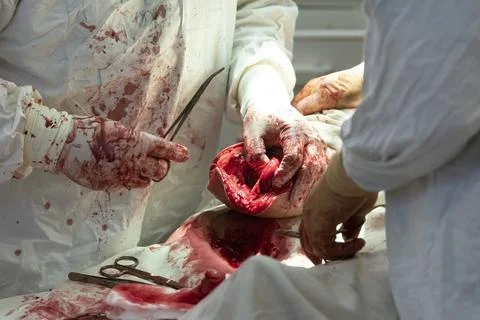 Surgeons Form The Stump Stockfoto's