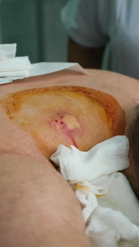 Surgeon's gloved hand treating a purulent atheroma on a patient's back Stock-Footage 337723360