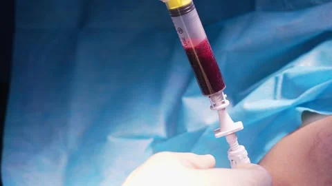 Surgeon's gloved hands aspirating red bone marrow from a patient's hip bone Video stock 345682129