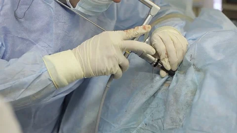 Surgeon's hand remove stones from the patient's kidney by a lithotripsy method. 库存影片 80967792