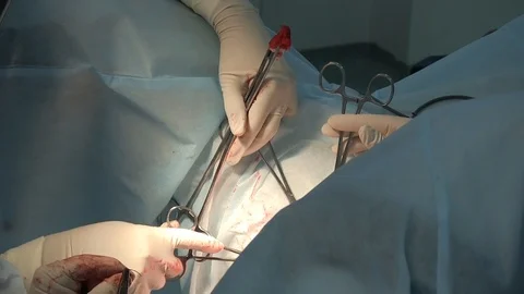 Surgeons hands and surgical instruments. clamps and scalpels, operating Stock Footage 125817011