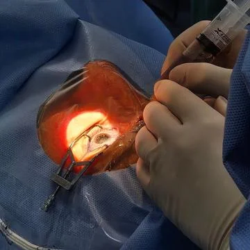 Surgeons hands during eye surgery 스톡 사진