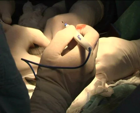 Surgeons' hands Stock Footage 343937