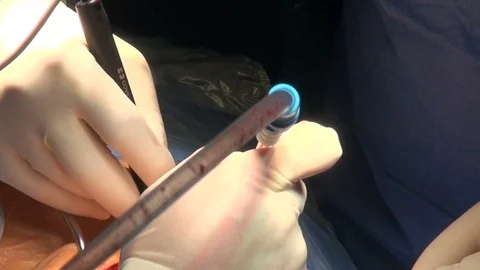 Surgeon's hands operate Stock Footage 115590539