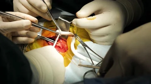 Surgeon's hands in sterile gloves performing operation with surgery tools. Stock Footage 131869080